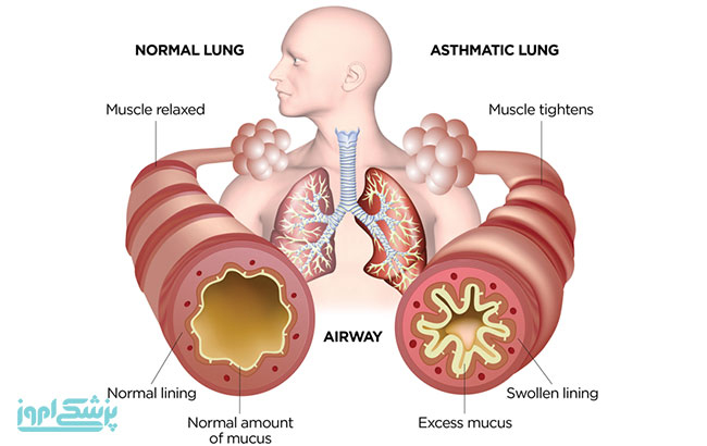 علائم،عوارض و درمان بیماری آسم و نشانه های آن